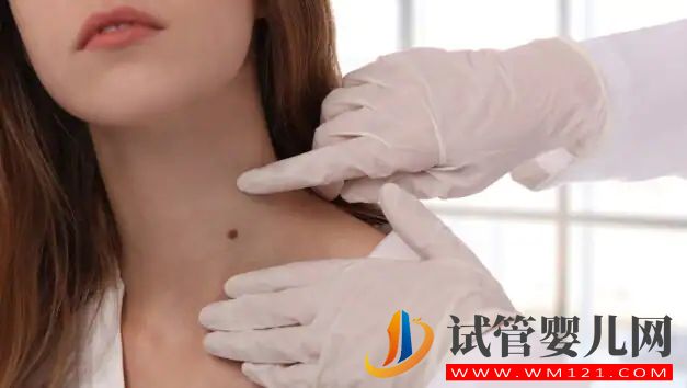 你有痣嗎？這是去除它們的 6 種正確方法(圖3)