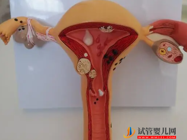 圖解多囊卵巢的不同類型，是輕是重看完見分曉(圖1)