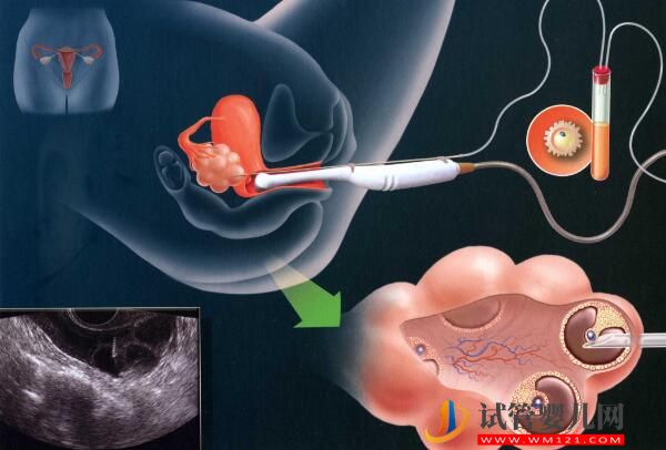 去老撾做試管嬰兒過程痛苦嗎？(圖1)