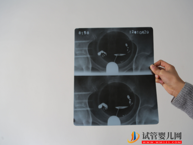 備孕夫妻天天同房也懷不上，警惕5大疾病導致的排卵障礙！(圖2)