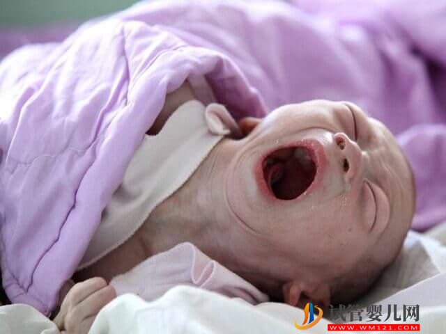 19號染色體片段缺失的小孩行為會有哪些表現(xiàn)?(圖1) 19號染色體片段缺失的小孩行為會有哪些表現(xiàn)?(圖1)