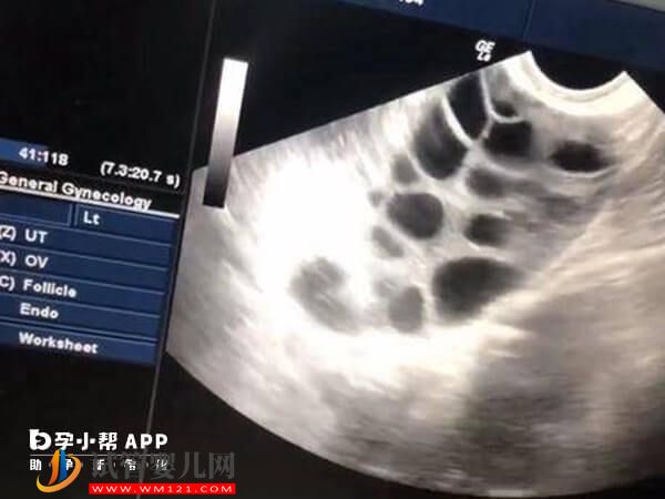 一分鐘get重慶市婦幼試管嬰兒，內含各項技術介紹及成本解析(圖3)