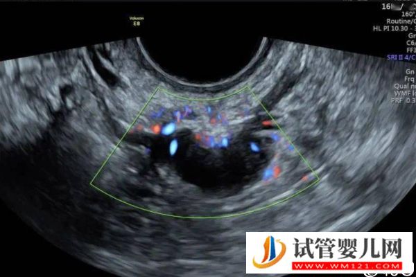取卵后醫(yī)生說(shuō)下個(gè)月移植是什么意思,是不是懷孕瞧完清楚(圖3) 取卵后醫(yī)生說(shuō)下個(gè)月移植是什么意思,是不是懷孕瞧完清楚(圖3)