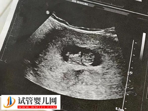試管嬰兒多久可見胎心(圖1)