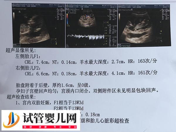 日本試管嬰兒雙胞胎幾率有多大(圖1)